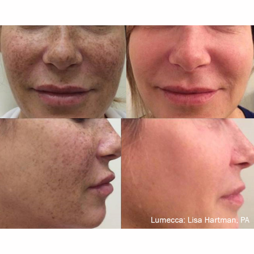 Lumecca IPL